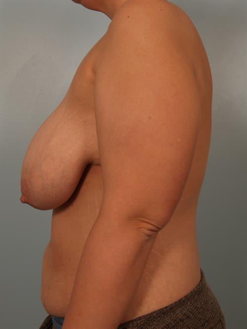 Breast Reduction Before Photo | Phoenix and Scottsdale, AZ | Scottsdale Center for Plastic Surgery
