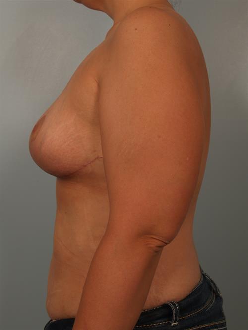 Breast Reduction After Photo | Phoenix and Scottsdale, AZ | Scottsdale Center for Plastic Surgery