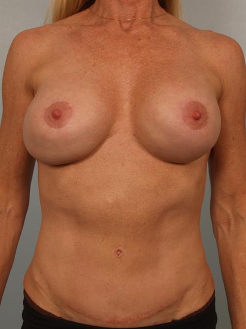 Fat Grafting Before Photo | Phoenix and Scottsdale, AZ | Scottsdale Center for Plastic Surgery