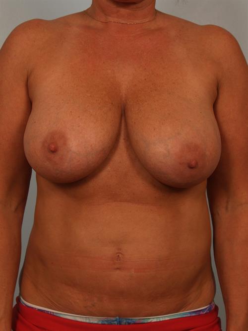 Breast Reduction Before Photo | Phoenix and Scottsdale, AZ | Scottsdale Center for Plastic Surgery
