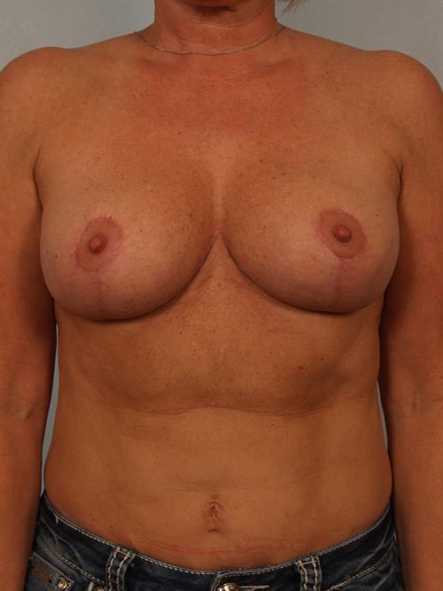 Breast Reduction After Photo | Phoenix and Scottsdale, AZ | Scottsdale Center for Plastic Surgery