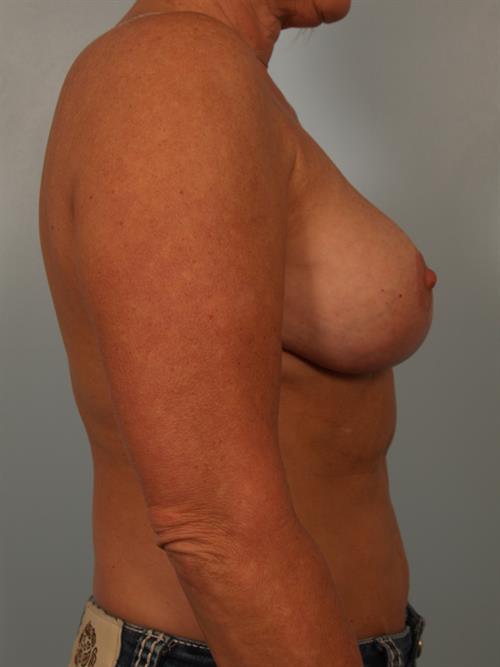 Breast Reduction After Photo | Phoenix and Scottsdale, AZ | Scottsdale Center for Plastic Surgery