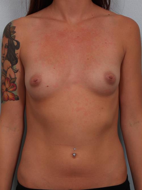 Fat Grafting Before Photo | Phoenix and Scottsdale, AZ | Scottsdale Center for Plastic Surgery