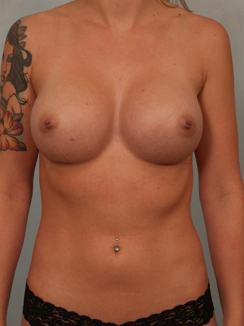 Fat Grafting After Photo | Phoenix and Scottsdale, AZ | Scottsdale Center for Plastic Surgery