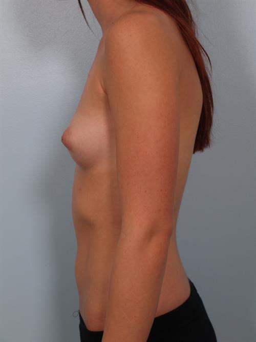 Fat Grafting Before Photo | Phoenix and Scottsdale, AZ | Scottsdale Center for Plastic Surgery