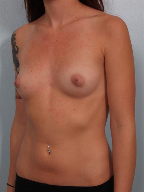 Fat Grafting Before Photo | Phoenix and Scottsdale, AZ | Scottsdale Center for Plastic Surgery