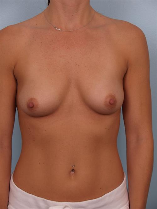 Breast Augmentation Before Photo | Phoenix and Scottsdale, AZ | Scottsdale Center for Plastic Surgery