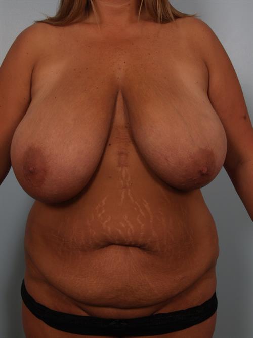 Mommy Makeover Before Photo | , |