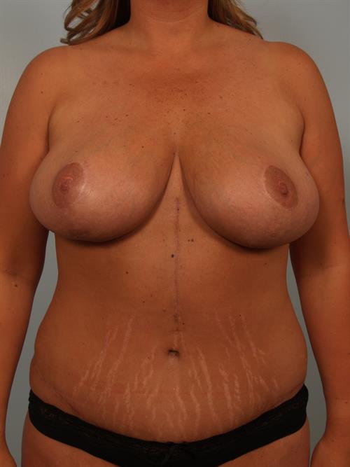 Power Assisted Liposuction After Photo | ,  | 