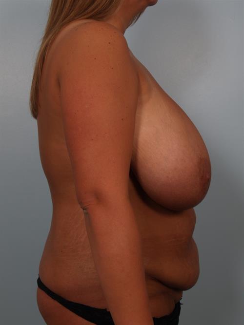 Breast Reduction Before Photo | ,  | 