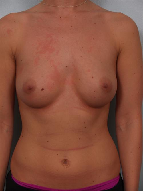 Breast Augmentation Before Photo | Phoenix and Scottsdale, AZ | Scottsdale Center for Plastic Surgery