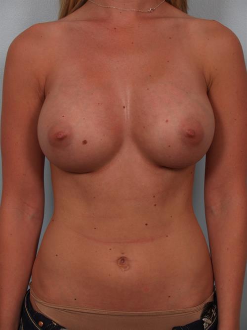 Breast Augmentation After Photo | Phoenix and Scottsdale, AZ | Scottsdale Center for Plastic Surgery