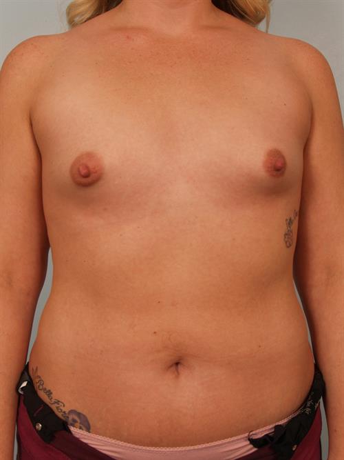 Tuberous Breast Surgery Before Photo | Phoenix and Scottsdale, AZ | Scottsdale Center for Plastic Surgery