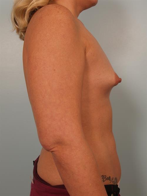 Tuberous Breast Surgery Before Photo | Phoenix and Scottsdale, AZ | Scottsdale Center for Plastic Surgery