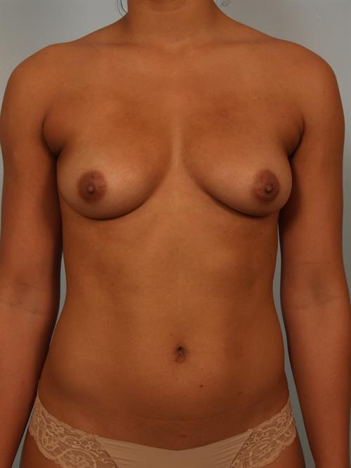 Breast Augmentation Before Photo | Phoenix and Scottsdale, AZ | Scottsdale Center for Plastic Surgery