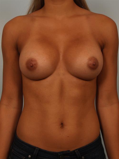 Breast Augmentation After Photo | Phoenix and Scottsdale, AZ | Scottsdale Center for Plastic Surgery