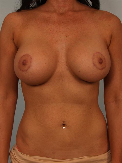 Breast Lift (Mastopexy) with Implants After Photo | Phoenix and Scottsdale, AZ | Scottsdale Center for Plastic Surgery