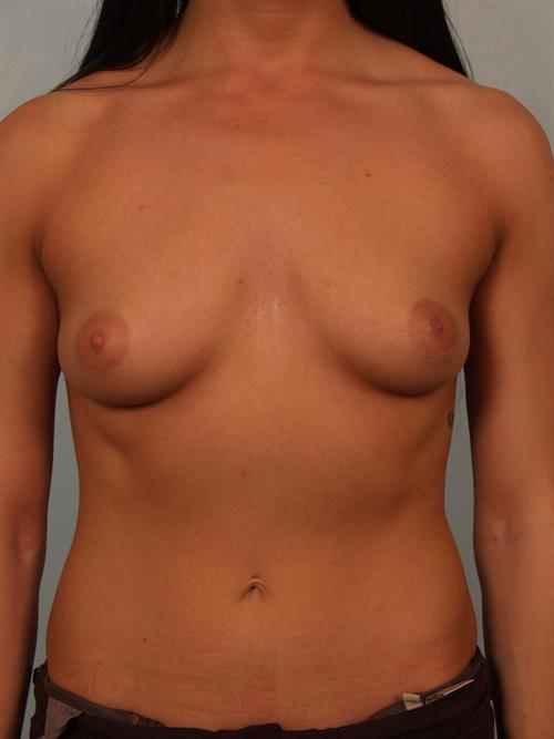 Breast Augmentation Before Photo | Phoenix and Scottsdale, AZ | Scottsdale Center for Plastic Surgery