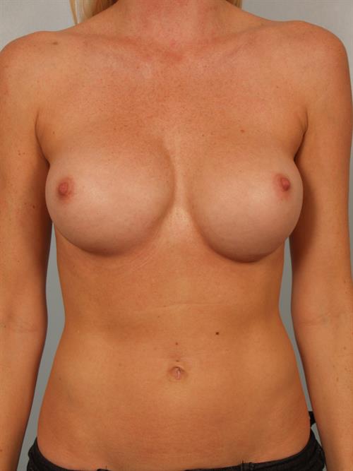 Revision Breast Surgery Before Photo | Phoenix and Scottsdale, AZ | Scottsdale Center for Plastic Surgery