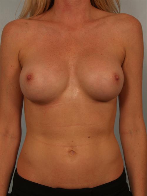 Revision Breast Surgery After Photo | Phoenix and Scottsdale, AZ | Scottsdale Center for Plastic Surgery