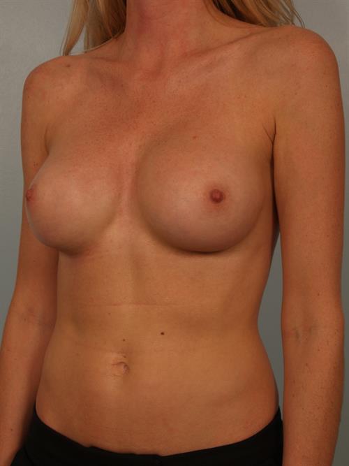 Breast Augmentation (Corrective) After Photo | ,  | 