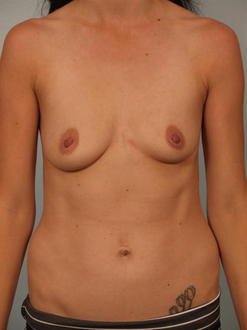 Breast Augmentation Before Photo | Phoenix and Scottsdale, AZ | Scottsdale Center for Plastic Surgery