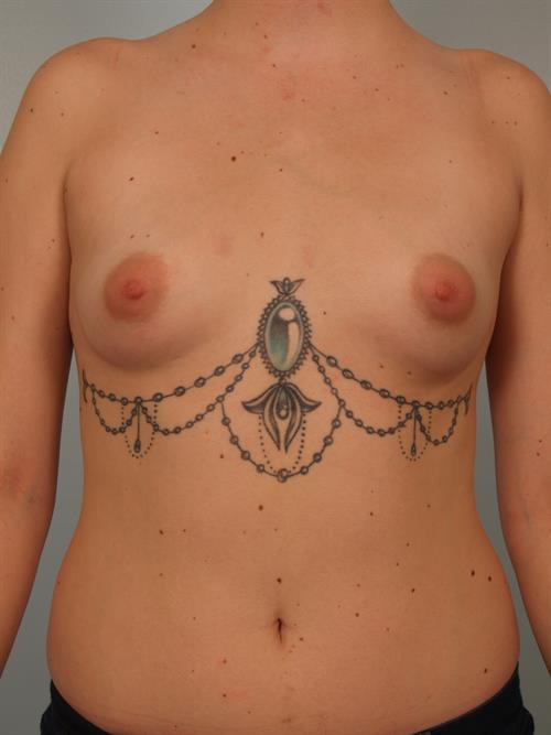 Breast Augmentation Before Photo | Phoenix and Scottsdale, AZ | Scottsdale Center for Plastic Surgery