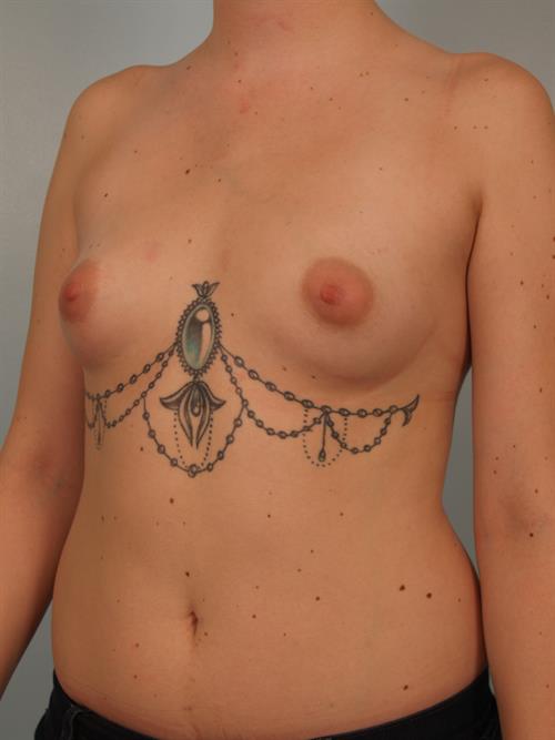 Breast Augmentation Before Photo | Phoenix and Scottsdale, AZ | Scottsdale Center for Plastic Surgery