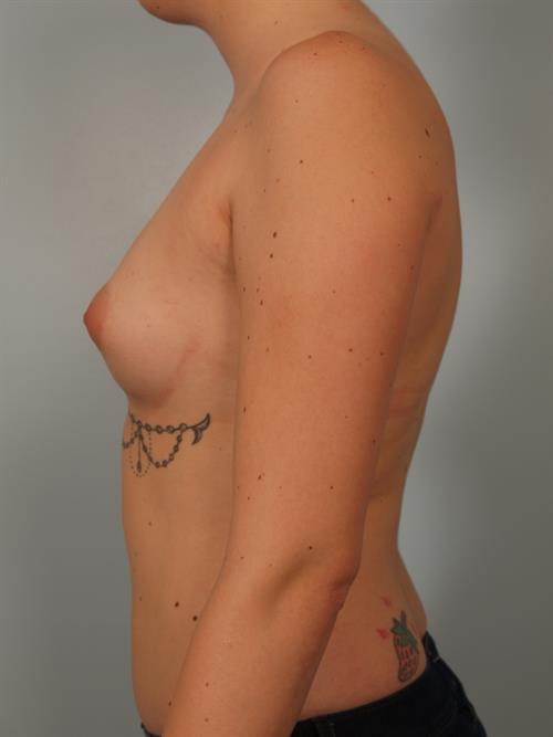 Breast Augmentation Before Photo | Phoenix and Scottsdale, AZ | Scottsdale Center for Plastic Surgery