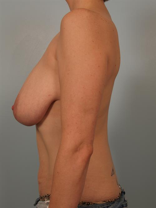 Breast Reduction Before Photo | Phoenix and Scottsdale, AZ | Scottsdale Center for Plastic Surgery