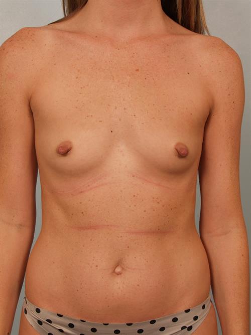 Breast Augmentation Before Photo | Phoenix and Scottsdale, AZ | Scottsdale Center for Plastic Surgery