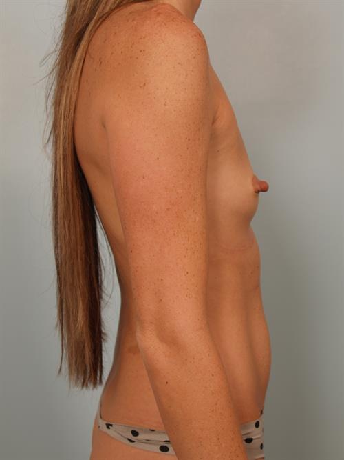 Breast Augmentation Before Photo | Phoenix and Scottsdale, AZ | Scottsdale Center for Plastic Surgery