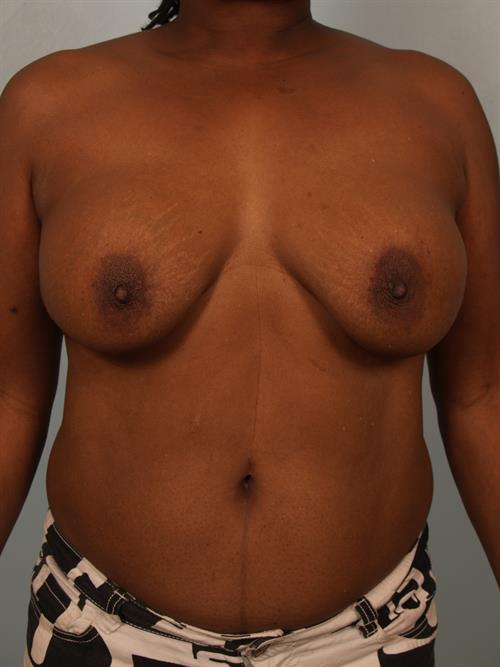 Revision Breast Surgery Before Photo | Phoenix and Scottsdale, AZ | Scottsdale Center for Plastic Surgery