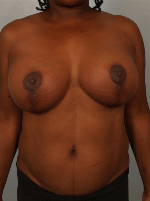 Revision Breast Surgery After Photo | Phoenix and Scottsdale, AZ | Scottsdale Center for Plastic Surgery