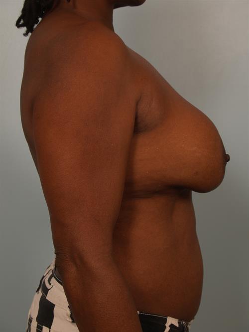 Revision Breast Surgery Before Photo | Phoenix and Scottsdale, AZ | Scottsdale Center for Plastic Surgery