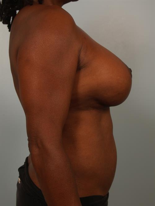 Revision Breast Surgery After Photo | Phoenix and Scottsdale, AZ | Scottsdale Center for Plastic Surgery