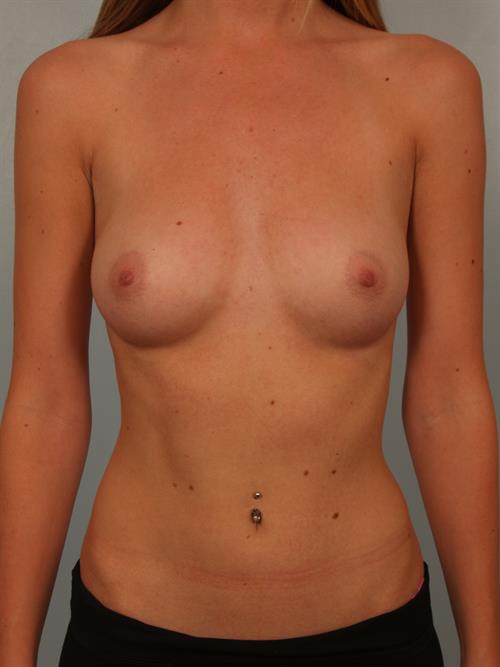 Breast Augmentation Before Photo | Phoenix and Scottsdale, AZ | Scottsdale Center for Plastic Surgery