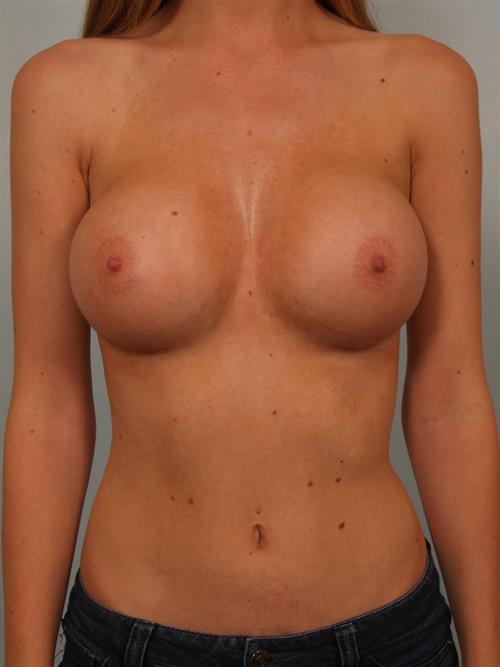 Breast Augmentation After Photo | Phoenix and Scottsdale, AZ | Scottsdale Center for Plastic Surgery