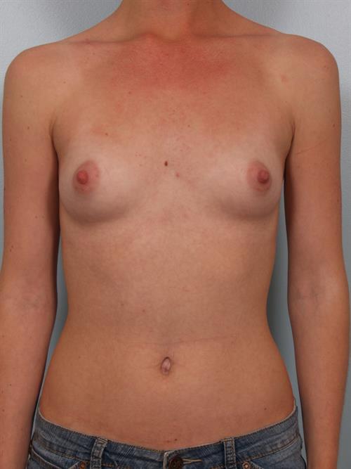 Breast Augmentation Before Photo | Phoenix and Scottsdale, AZ | Scottsdale Center for Plastic Surgery