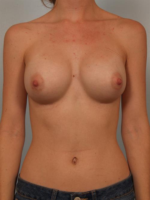 Breast Augmentation After Photo | Phoenix and Scottsdale, AZ | Scottsdale Center for Plastic Surgery
