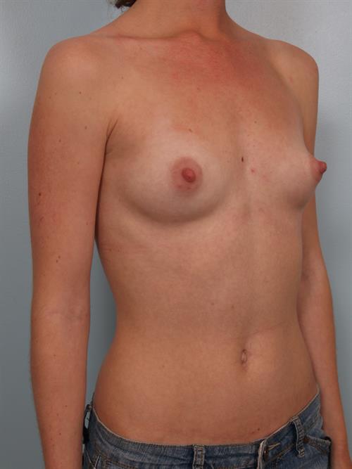 Breast Augmentation Before Photo | Phoenix and Scottsdale, AZ | Scottsdale Center for Plastic Surgery