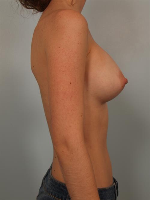 Breast Augmentation After Photo | Phoenix and Scottsdale, AZ | Scottsdale Center for Plastic Surgery