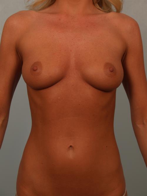 Breast Augmentation Before Photo | Phoenix and Scottsdale, AZ | Scottsdale Center for Plastic Surgery