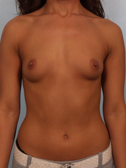 Breast Augmentation Before Photo | Phoenix and Scottsdale, AZ | Scottsdale Center for Plastic Surgery