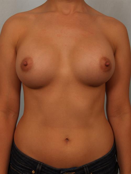 Breast Augmentation After Photo | ,  | 