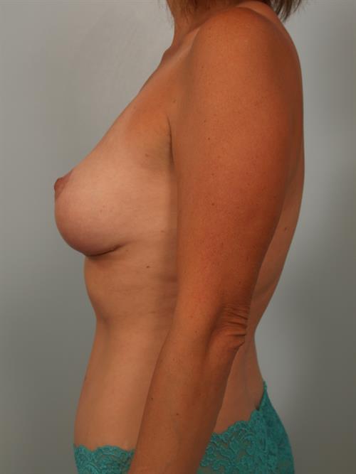Breast Lift (Mastopexy) After Photo | Phoenix and Scottsdale, AZ | Scottsdale Center for Plastic Surgery