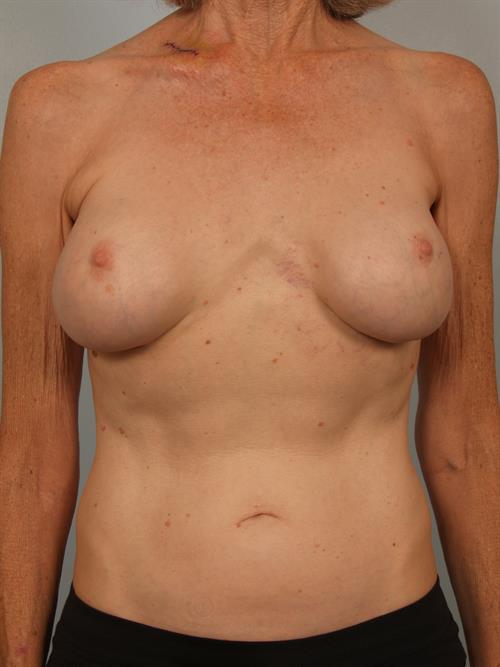 Fat Grafting Before Photo | Phoenix and Scottsdale, AZ | Scottsdale Center for Plastic Surgery