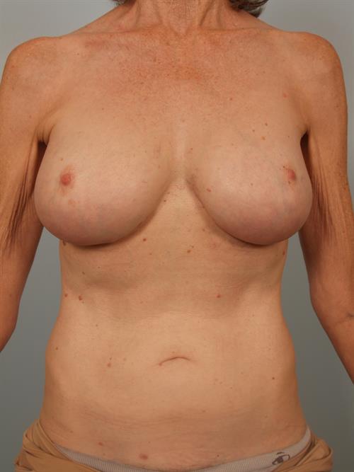 Fat Grafting After Photo | Phoenix and Scottsdale, AZ | Scottsdale Center for Plastic Surgery