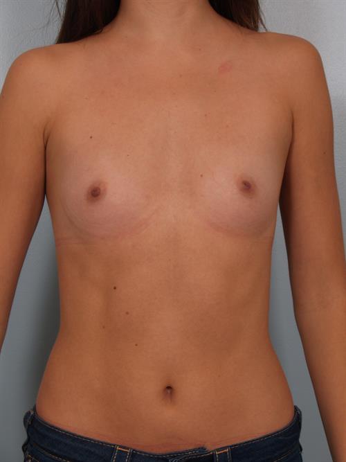 Breast Augmentation Before Photo | Phoenix and Scottsdale, AZ | Scottsdale Center for Plastic Surgery