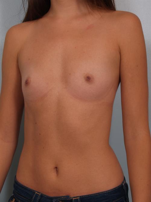 Breast Augmentation Before Photo | Phoenix and Scottsdale, AZ | Scottsdale Center for Plastic Surgery